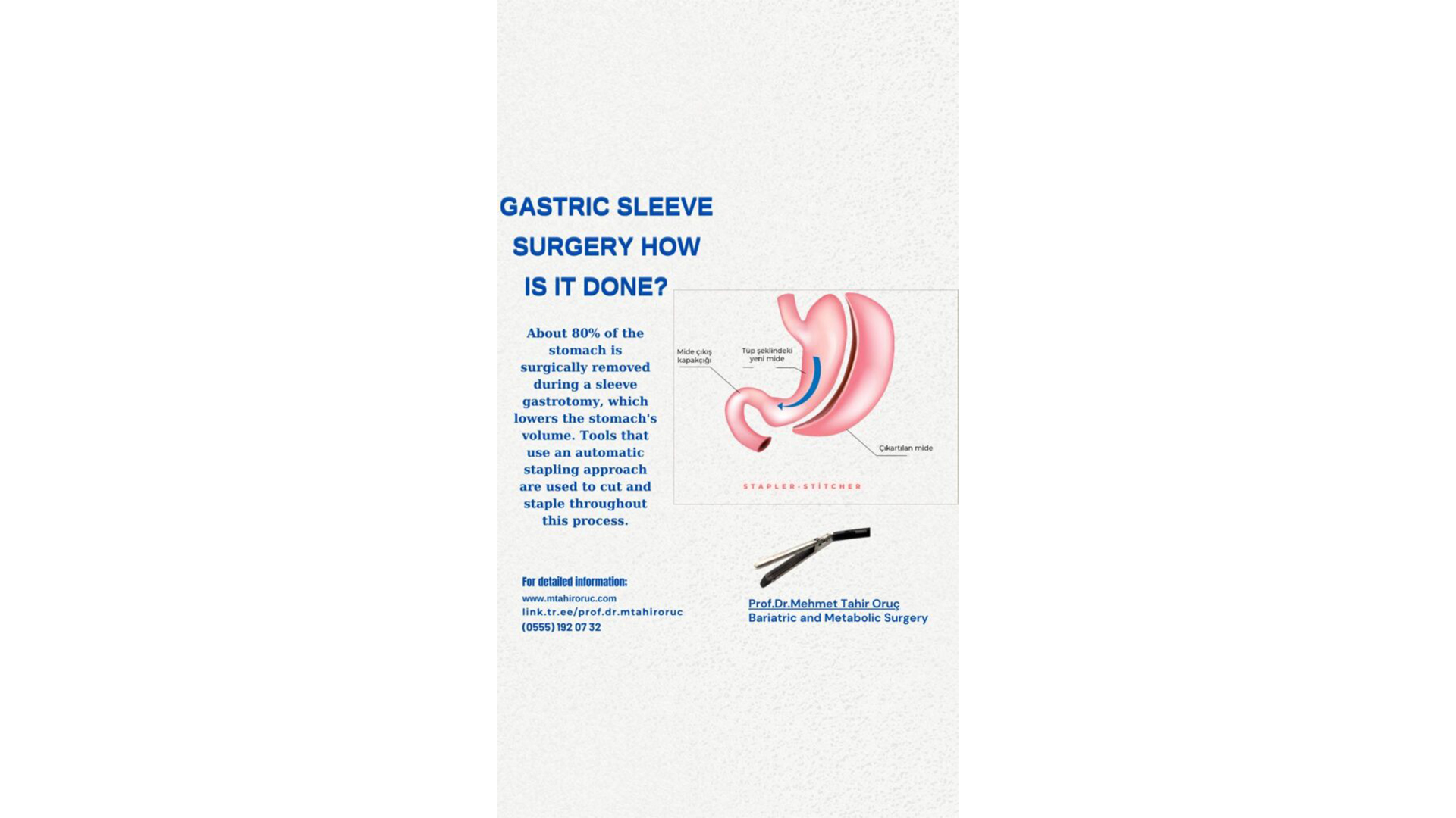 WHY SHOULD I PREFER GASTRİC SLEEVE OPERATİON ?